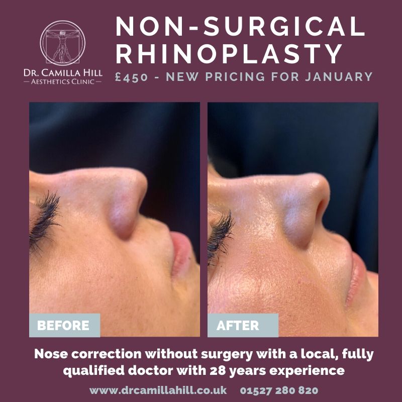 Dr Camilla Hill Non-surgical rhinoplasty could help you achieve the look you want in 2020