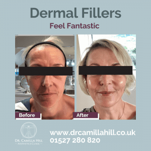 Dermal fillers are used to smooth, plump and add volume.