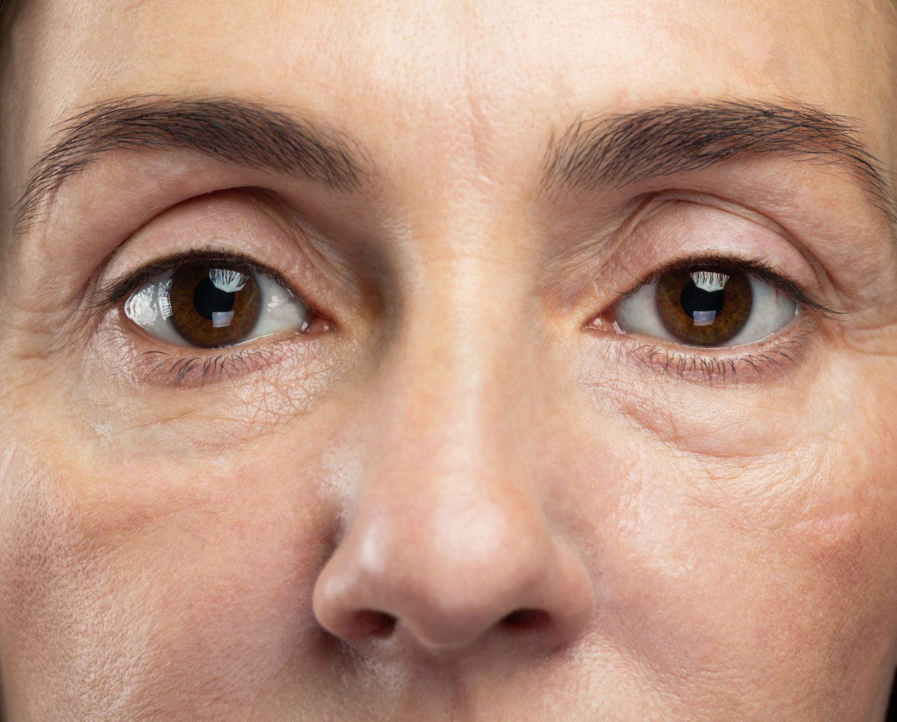 An effective alternative to surgery: Using Plexr to remove eye bags - Dr  Camilla Hill