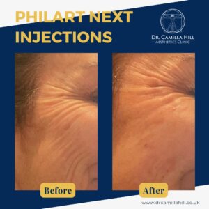 Dr Camilla Hill Facial Aesthetics | Chroma PhilArt Treatments Before and After