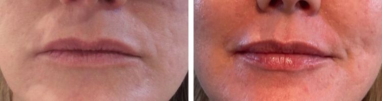 Dr Camilla Hill Dermal Filler Facelift Before and After-Lips